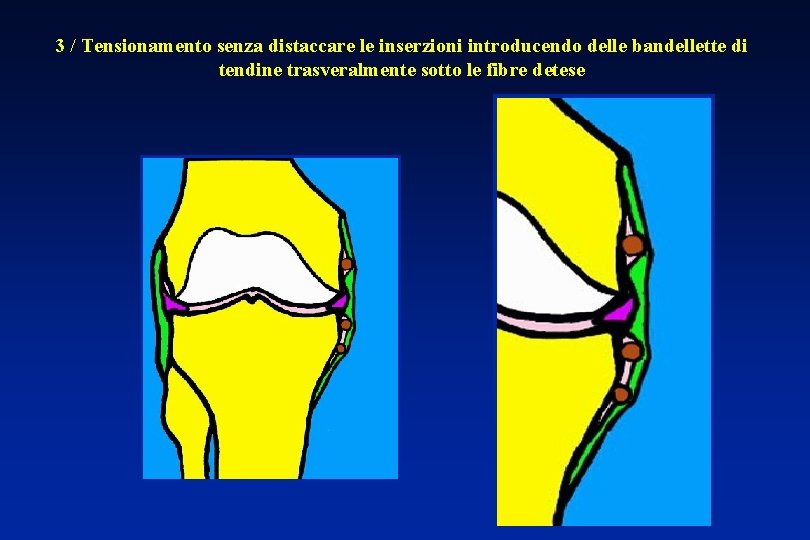 3 / Tensionamento senza distaccare le inserzioni introducendo delle bandellette di tendine trasveralmente sotto