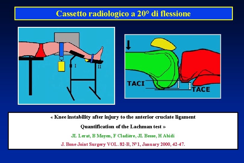 Cassetto radiologico a 20° di flessione « Knee instability after injury to the anterior