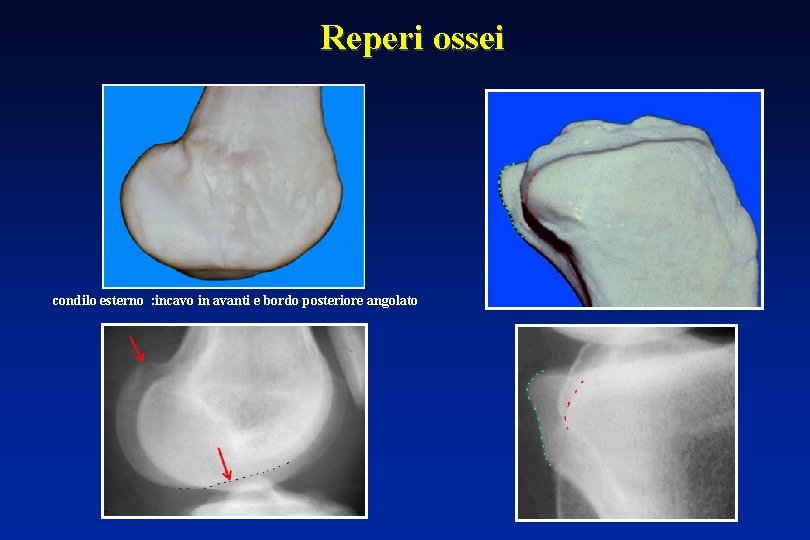 Reperi ossei condilo esterno : incavo in avanti e bordo posteriore angolato 