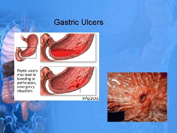 Gastric Ulcers 
