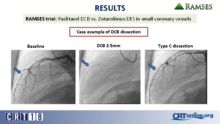 RESULTS RAMSES trial: Paclitaxel DCB vs. Zotarolimus DES in small coronary vessels Case example