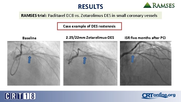 RESULTS RAMSES trial: Paclitaxel DCB vs. Zotarolimus DES in small coronary vessels Case example