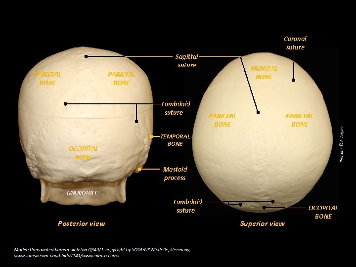 Coronal suture Sagittal suture PARIETAL BONE FRONTAL BONE PARIETAL BONE Lambdoid suture OCCIPITAL BONE