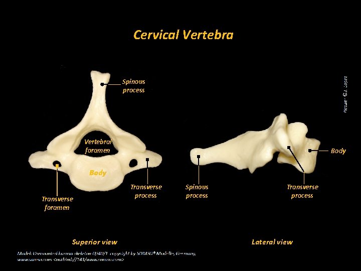 Cervical Vertebra Spinous process Vertebral foramen Body Transverse foramen Superior view Transverse process Spinous