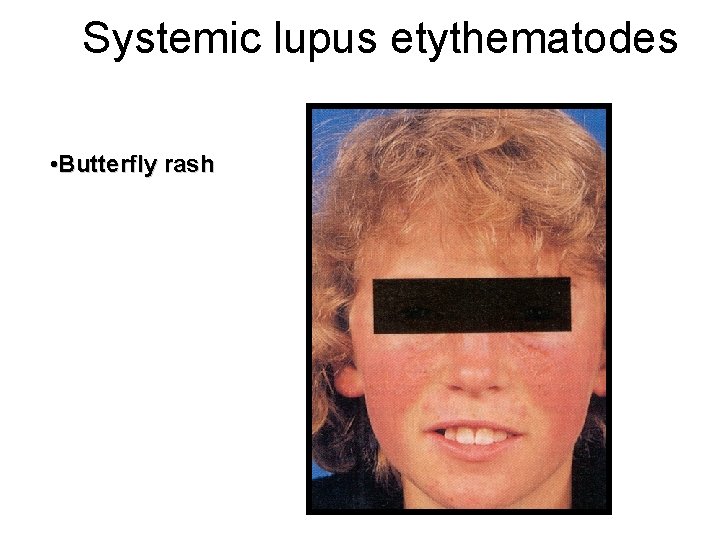 Systemic lupus etythematodes • Butterfly rash 