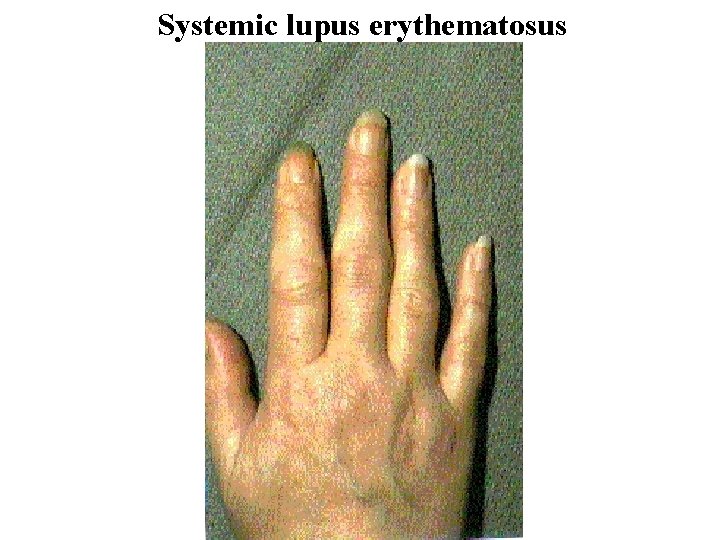 Systemic lupus erythematosus 