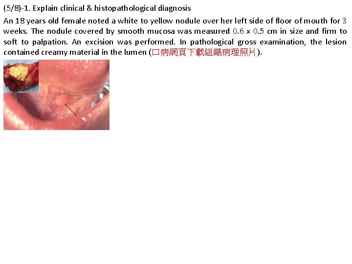 (5/8)-1. Explain clinical & histopathological diagnosis An 18 years old female noted a white