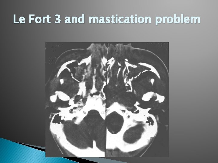 Le Fort 3 and mastication problem 
