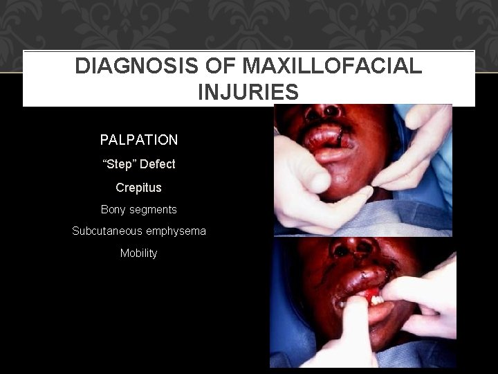 DIAGNOSIS OF MAXILLOFACIAL INJURIES PALPATION “Step” Defect Crepitus Bony segments Subcutaneous emphysema Mobility 