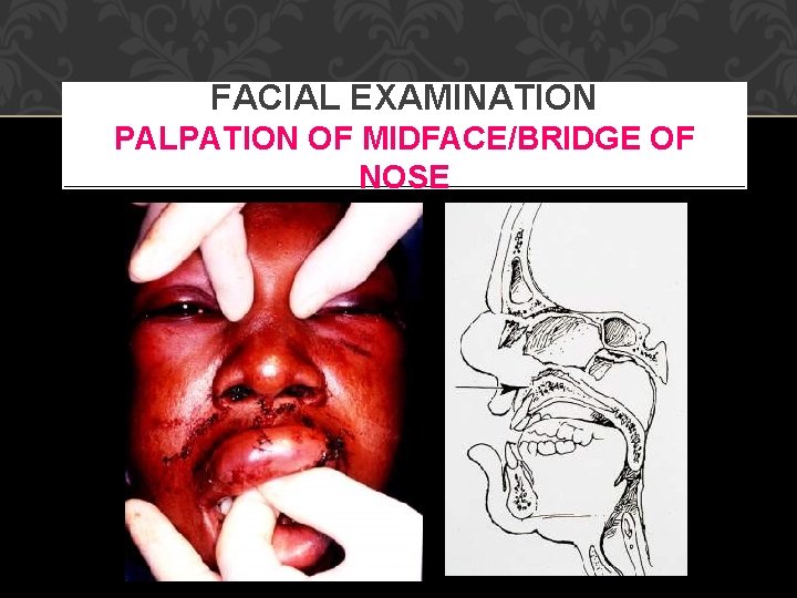FACIAL EXAMINATION PALPATION OF MIDFACE/BRIDGE OF NOSE 