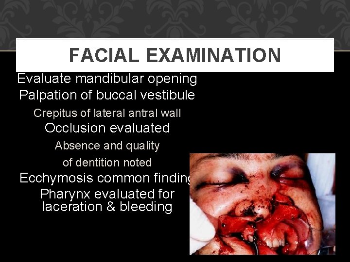 FACIAL EXAMINATION Evaluate mandibular opening Palpation of buccal vestibule Crepitus of lateral antral wall