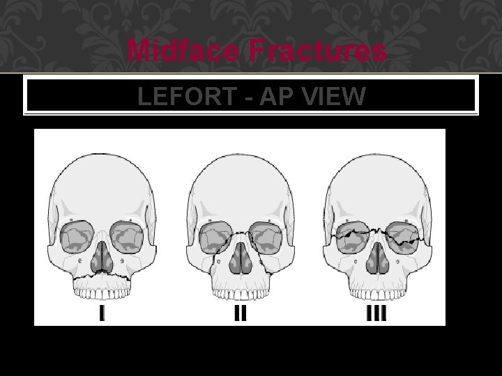 Midface Fractures LEFORT - AP VIEW 