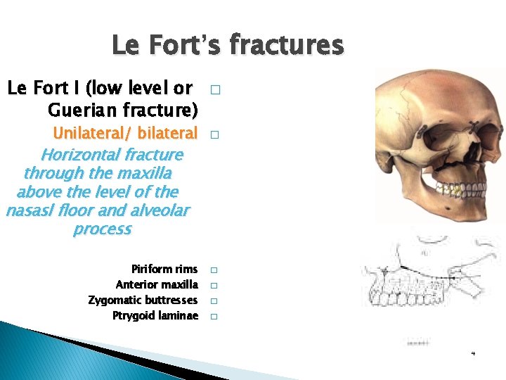 Le Fort’s fractures Le Fort I (low level or Guerian fracture) Unilateral/ bilateral �