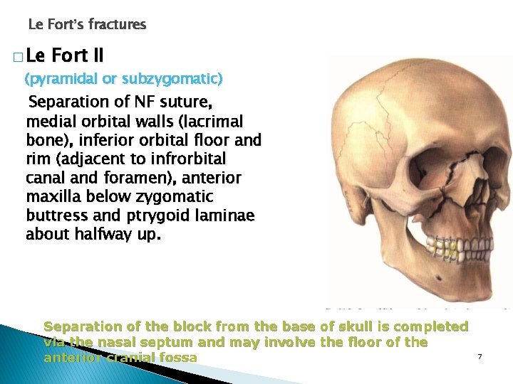 Le Fort’s fractures � Le Fort II (pyramidal or subzygomatic) Separation of NF suture,