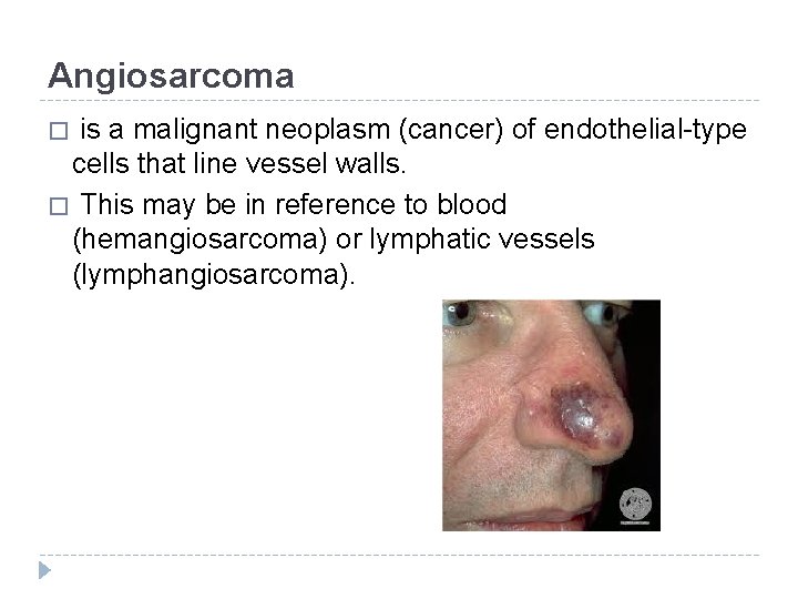 Angiosarcoma is a malignant neoplasm (cancer) of endothelial-type cells that line vessel walls. �
