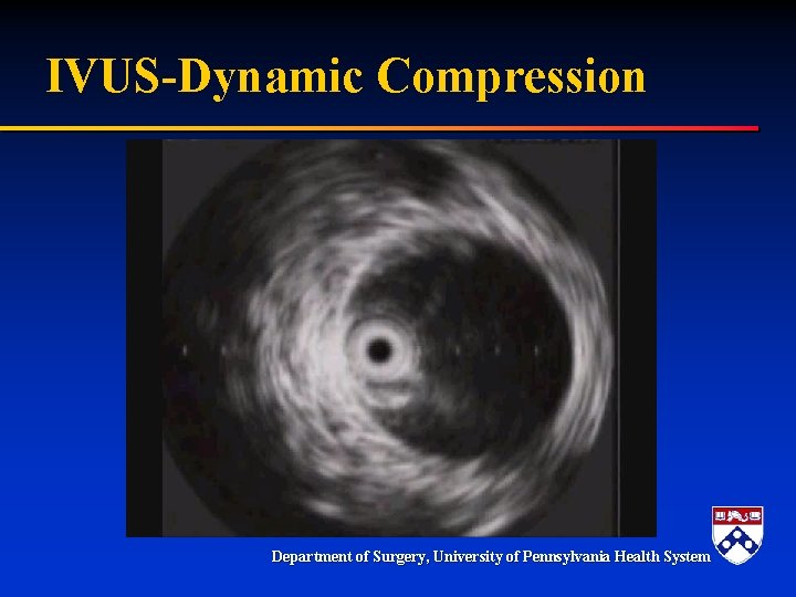 IVUS-Dynamic Compression Department of Surgery, University of Pennsylvania Health System IVUS-Dynamic Compression Department of Surgery, University of Pennsylvania Health System
