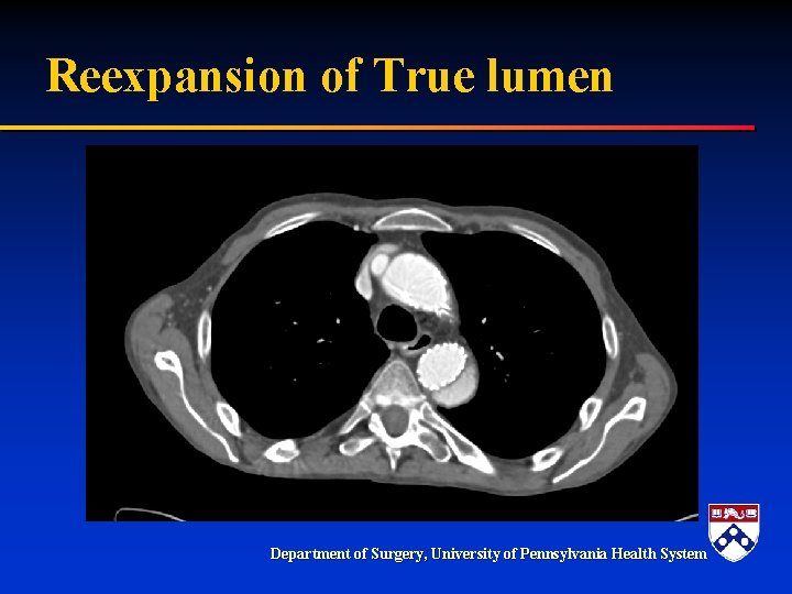 Reexpansion of True lumen Department of Surgery, University of Pennsylvania Health System Reexpansion of True lumen Department of Surgery, University of Pennsylvania Health System