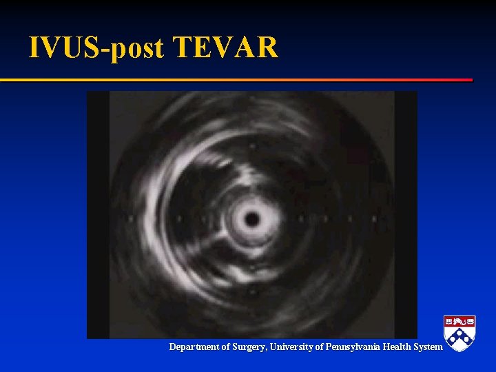 IVUS-post TEVAR Department of Surgery, University of Pennsylvania Health System IVUS-post TEVAR Department of Surgery, University of Pennsylvania Health System