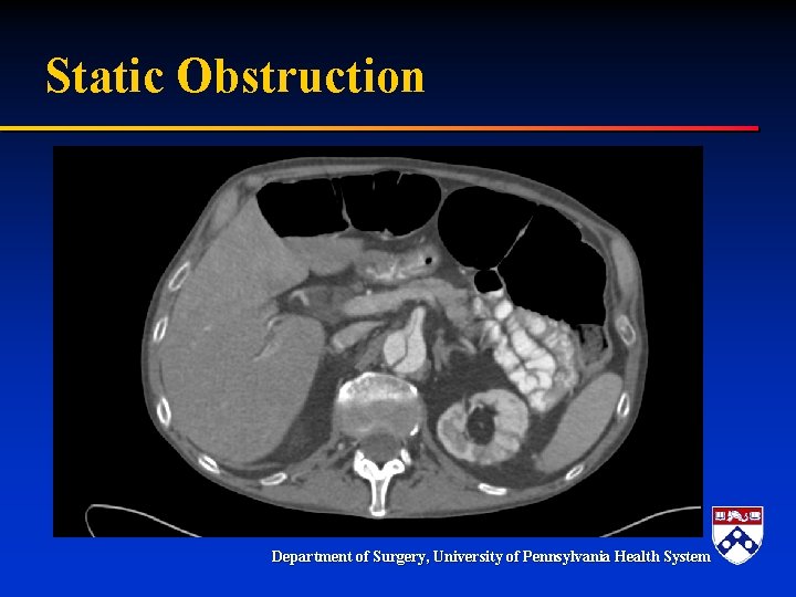 Static Obstruction Department of Surgery, University of Pennsylvania Health System Static Obstruction Department of Surgery, University of Pennsylvania Health System