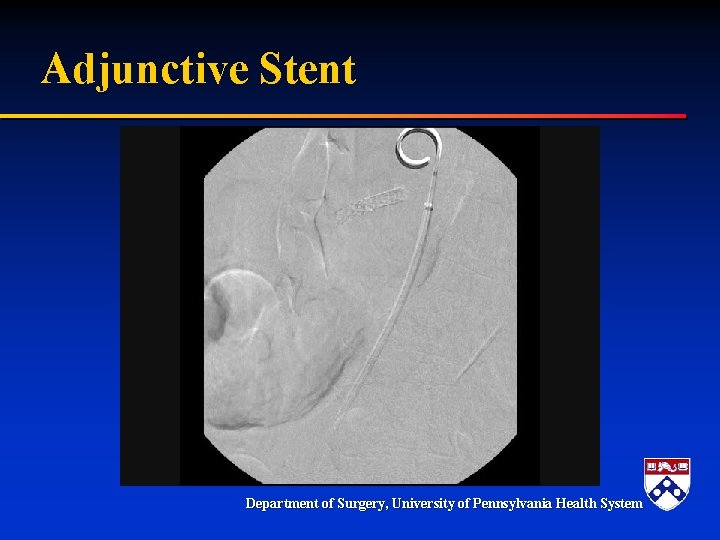 Adjunctive Stent Department of Surgery, University of Pennsylvania Health System Adjunctive Stent Department of Surgery, University of Pennsylvania Health System