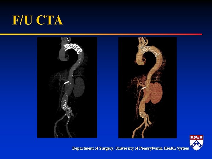 F/U CTA Department of Surgery, University of Pennsylvania Health System F/U CTA Department of Surgery, University of Pennsylvania Health System