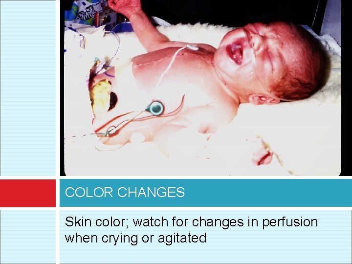 COLOR CHANGES Skin color; watch for changes in perfusion when crying or agitated 