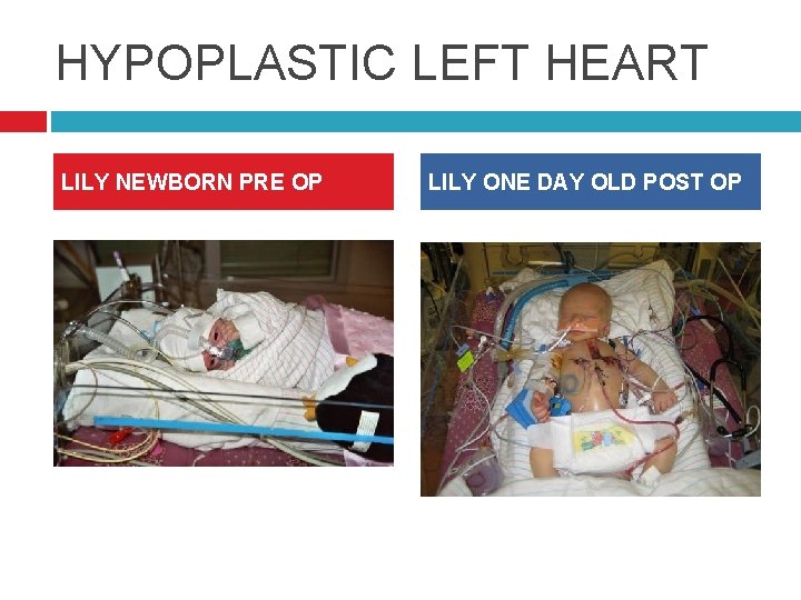 HYPOPLASTIC LEFT HEART LILY NEWBORN PRE OP LILY ONE DAY OLD POST OP 