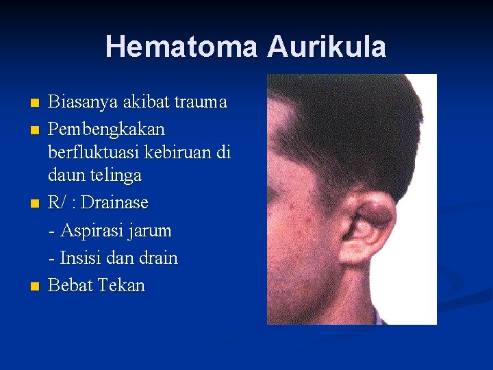 Hematoma Aurikula n n Biasanya akibat trauma Pembengkakan berfluktuasi kebiruan di daun telinga R/