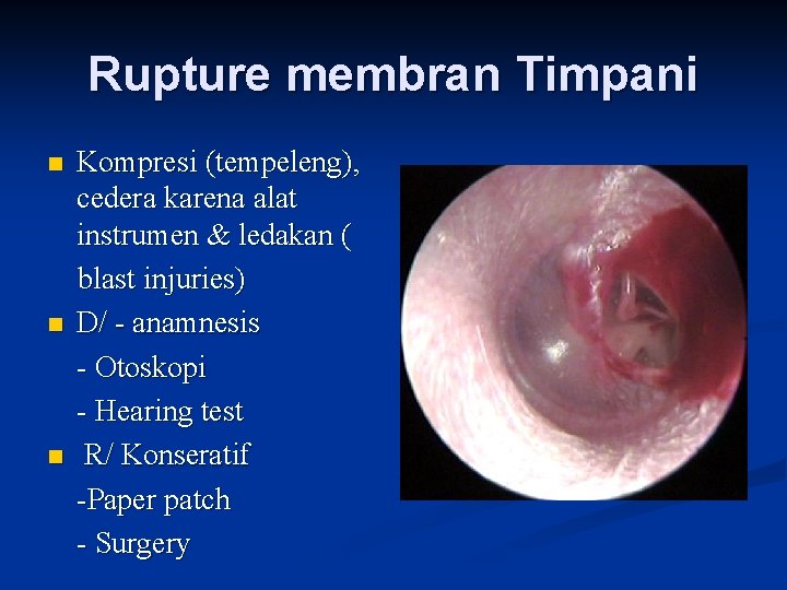 Rupture membran Timpani n n n Kompresi (tempeleng), cedera karena alat instrumen & ledakan