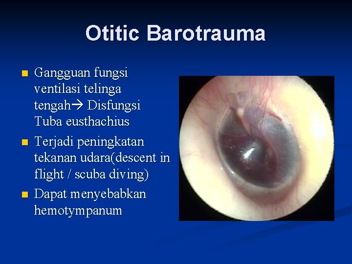 Otitic Barotrauma n n n Gangguan fungsi ventilasi telinga tengah Disfungsi Tuba eusthachius Terjadi