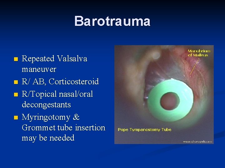 Barotrauma n n Repeated Valsalva maneuver R/ AB, Corticosteroid R/Topical nasal/oral decongestants Myringotomy &