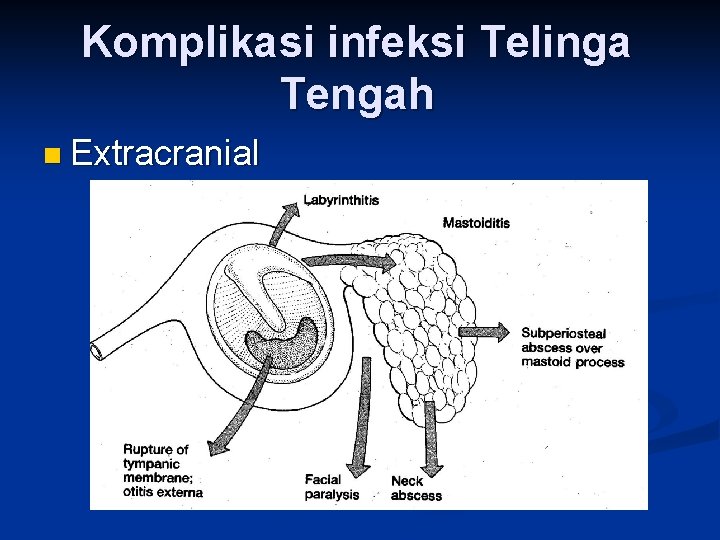 Komplikasi infeksi Telinga Tengah n Extracranial 