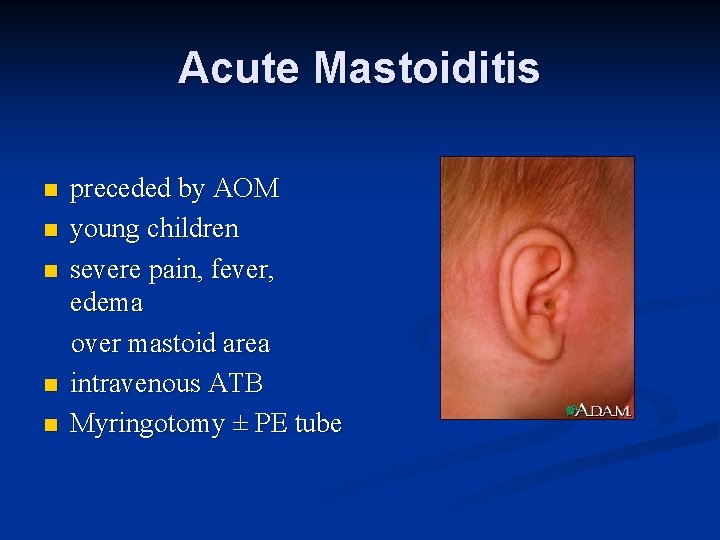 Acute Mastoiditis n n n preceded by AOM young children severe pain, fever, edema