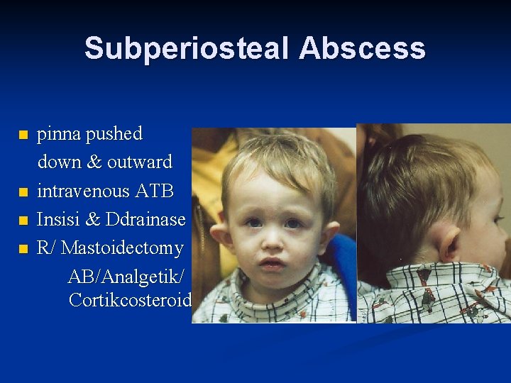 Subperiosteal Abscess n n pinna pushed down & outward intravenous ATB Insisi & Ddrainase