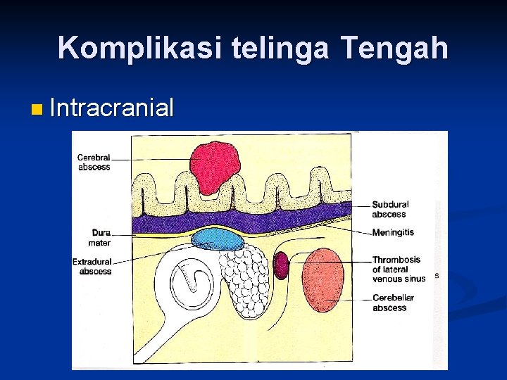 Komplikasi telinga Tengah n Intracranial 