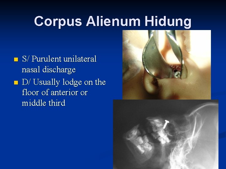 Corpus Alienum Hidung n n S/ Purulent unilateral nasal discharge D/ Usually lodge on