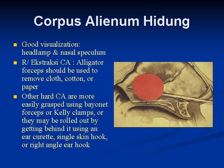 Corpus Alienum Hidung n n n Good visualization: headlamp & nasal speculum R/ Ekstraksi