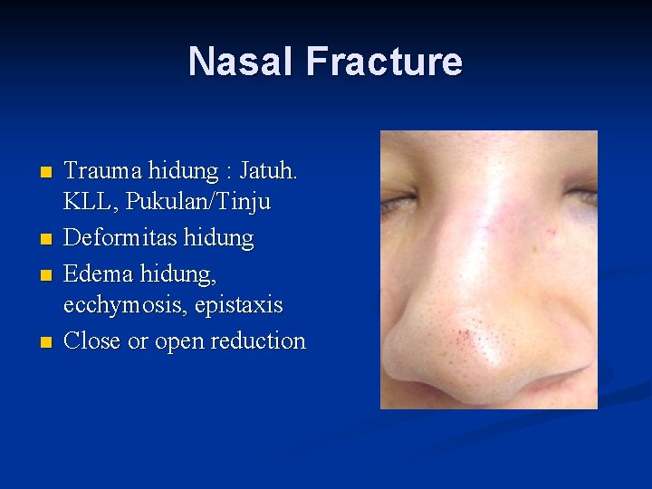 Nasal Fracture n n Trauma hidung : Jatuh. KLL, Pukulan/Tinju Deformitas hidung Edema hidung,