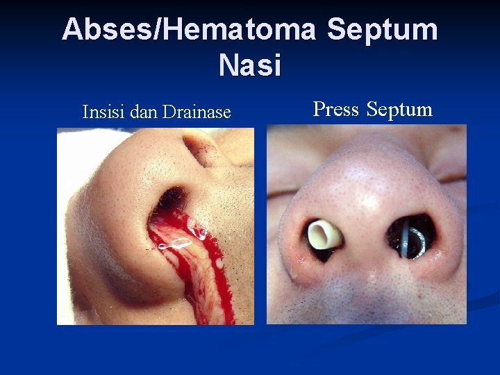 Abses/Hematoma Septum Nasi Insisi dan Drainase Press Septum 