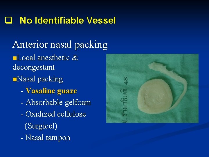 q No Identifiable Vessel Anterior nasal packing n. Local anesthetic & decongestant n. Nasal