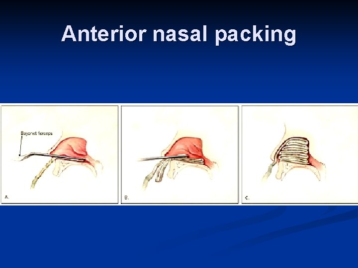 Anterior nasal packing 