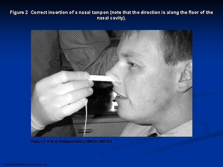 Figure 2 Correct insertion of a nasal tampon (note that the direction is along