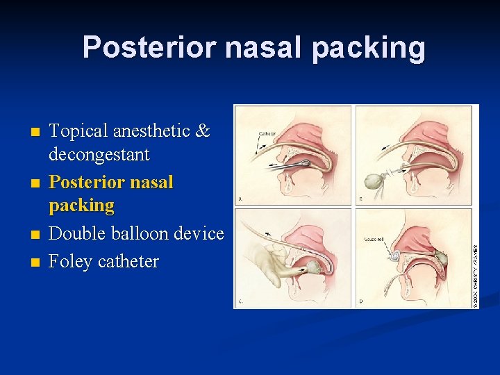 Posterior nasal packing n n Topical anesthetic & decongestant Posterior nasal packing Double balloon