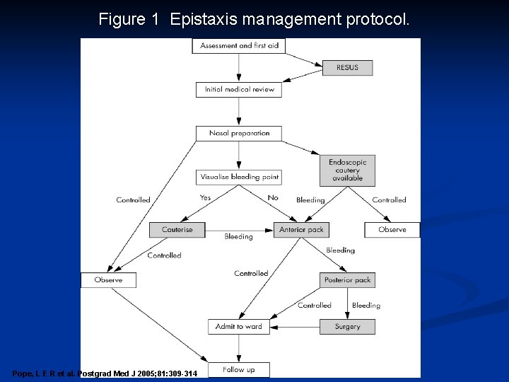 Figure 1 Epistaxis management protocol. Pope, L E R et al. Postgrad Med J