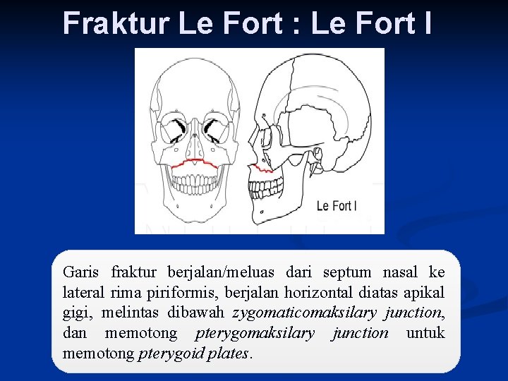 Fraktur Le Fort : Le Fort I Garis fraktur berjalan/meluas dari septum nasal ke