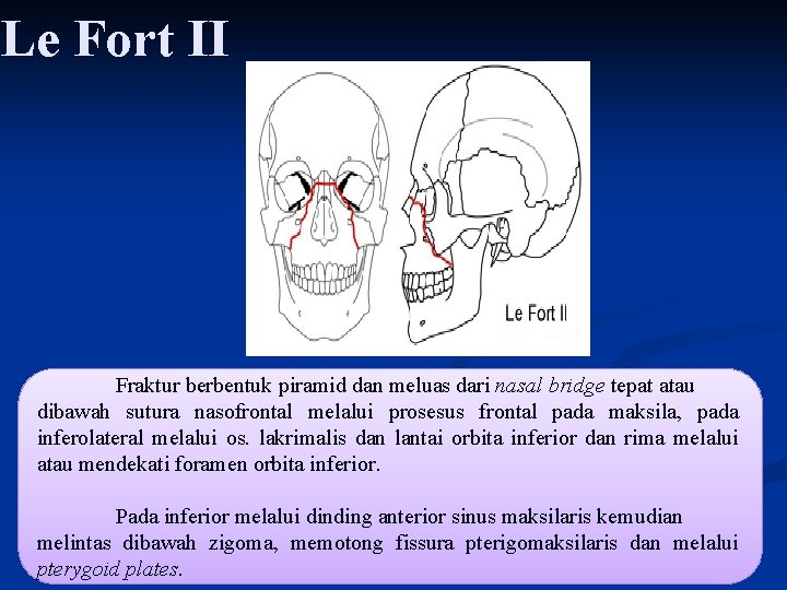 Le Fort II Fraktur berbentuk piramid dan meluas dari nasal bridge tepat atau dibawah