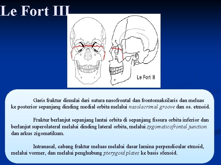 Le Fort III Garis fraktur dimulai dari sutura nasofrontal dan frontomaksilaris dan meluas ke