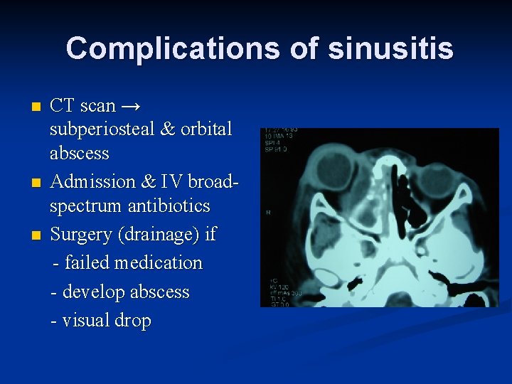 Complications of sinusitis n n n CT scan → subperiosteal & orbital abscess Admission