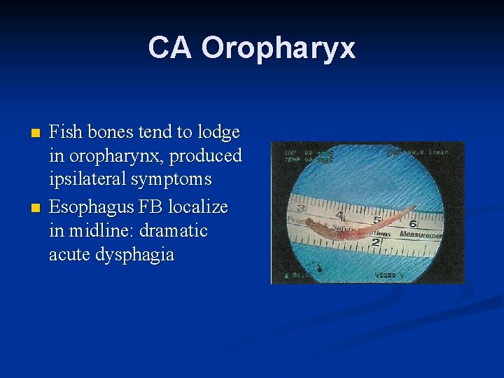 CA Oropharyx n n Fish bones tend to lodge in oropharynx, produced ipsilateral symptoms