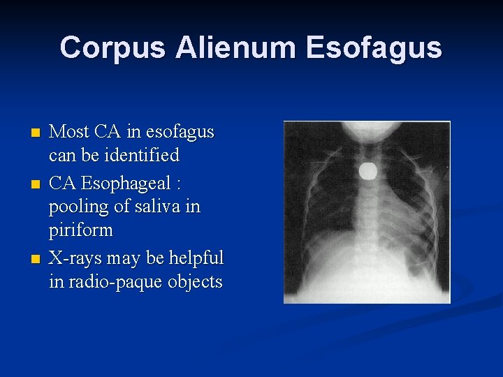 Corpus Alienum Esofagus n n n Most CA in esofagus can be identified CA